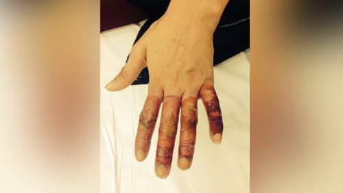 Her hands are still in the process of healing. (Imgur)