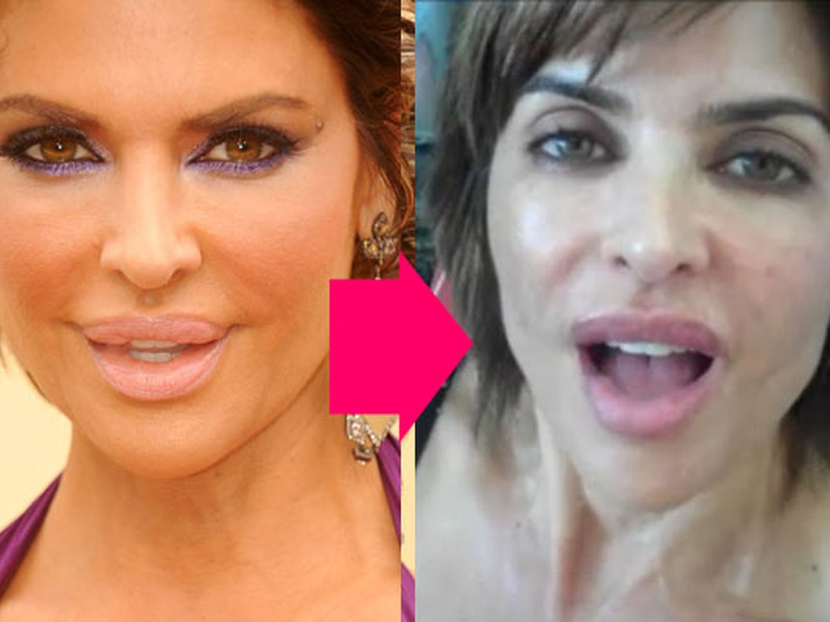 Lisa rinna before and after plastic surgery