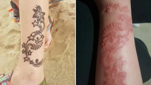 Eight-year-old South Australian Madison Gutschlag has been left with a scar after getting a henna tattoo.