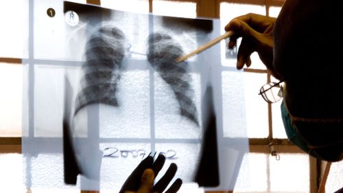 US researchers develop rapid blood test for tuberculosis which could save millions of lives