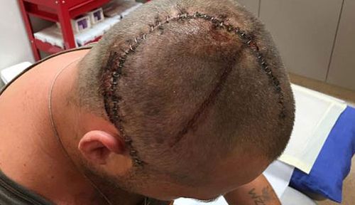 Benjamin Lightbody needed brain surgery after the prison yard attack. (Supplied).