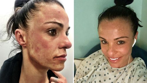 Carly Buhagiar says she suffered from skins lesions, rashes, weight and hair loss as a result of the mould. She is pictured here before and after her treatment in the US. (Photo: Carly Buhagiar)