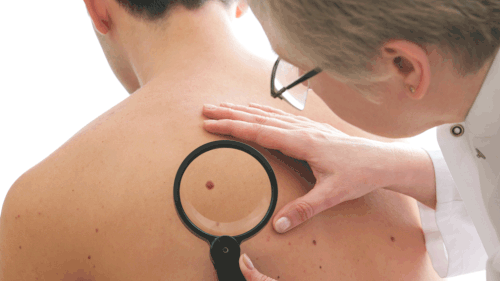 "Melanomas are the most dangerous type of skin cancer," QIMR Berghofer advises. (Getty)