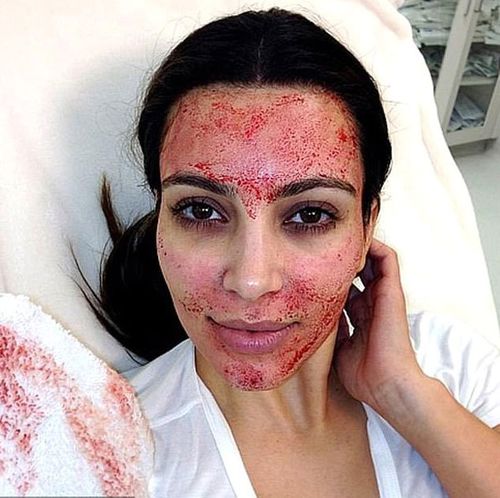 Kim Kardashian gets a vampire facial.