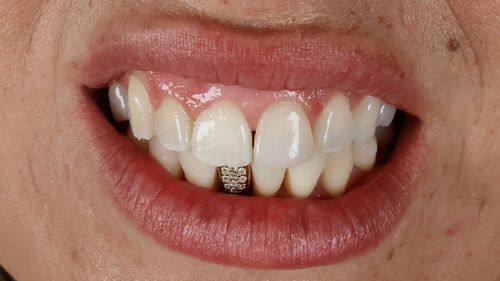 Este implante dentário permanente de ouro e diamante foi criado para preencher o local onde faltava um dente de um cliente.