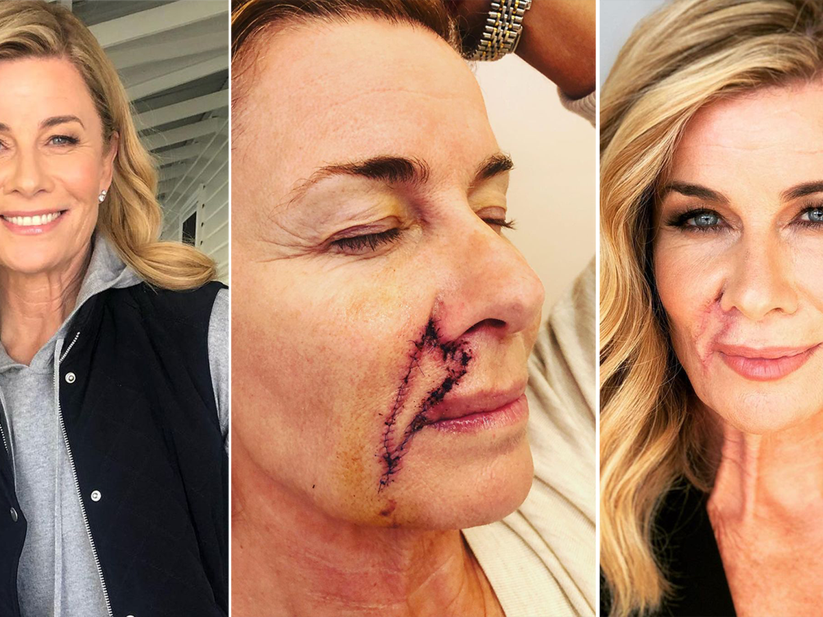 Deborah Hutton Shares Skin Cancer Update With Urgent Warning One Year After Invasive Surgery 9honey