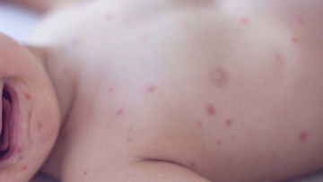 Health bosses are warning people in Sydney&#x27;s west to be alert for symptoms of measles after a baby was ﻿diagnosed.