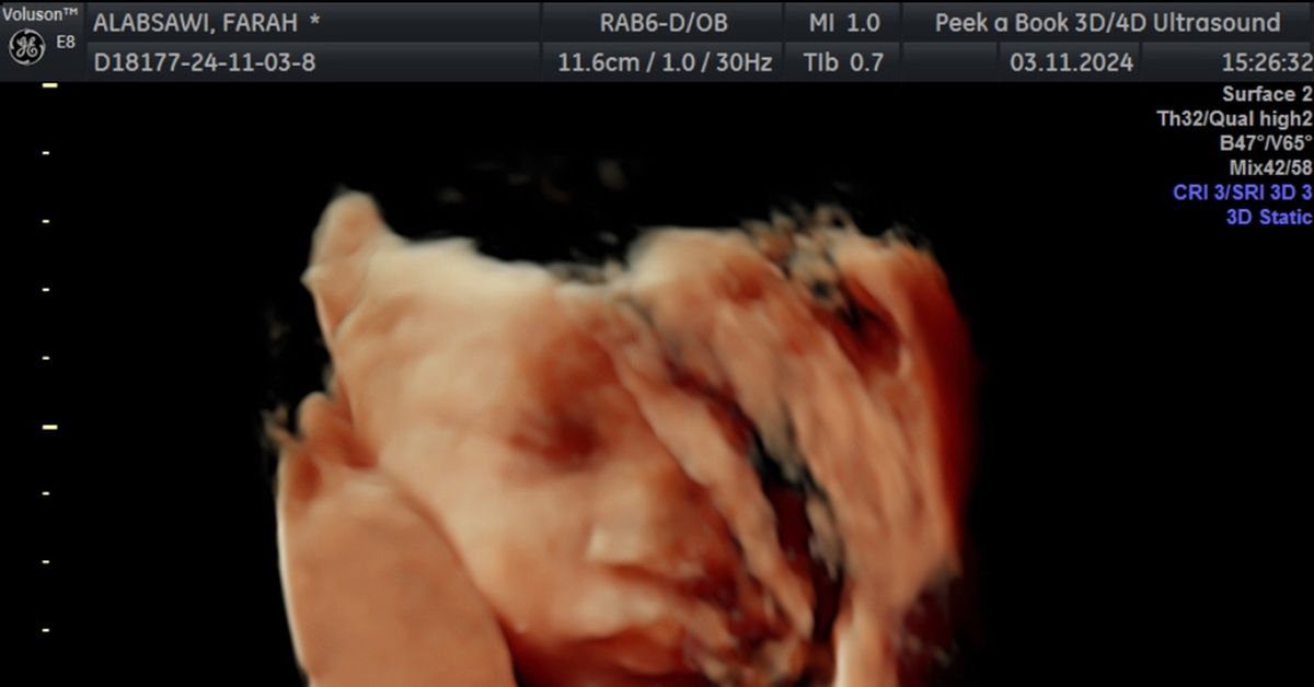 Serious health problem hiding in baby twin's ultrasound