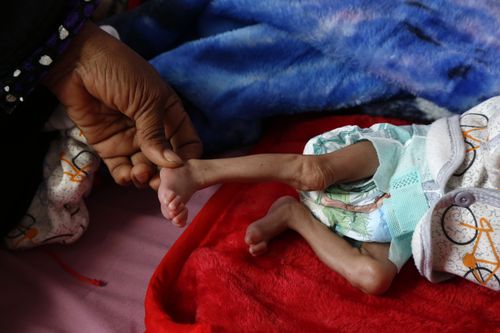 The tiny foot of malnourished Yemeni child