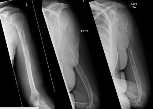 X-rays show the woman's  left shoulder bones disintegrate over a matter of months. (BMJ Case Reports)