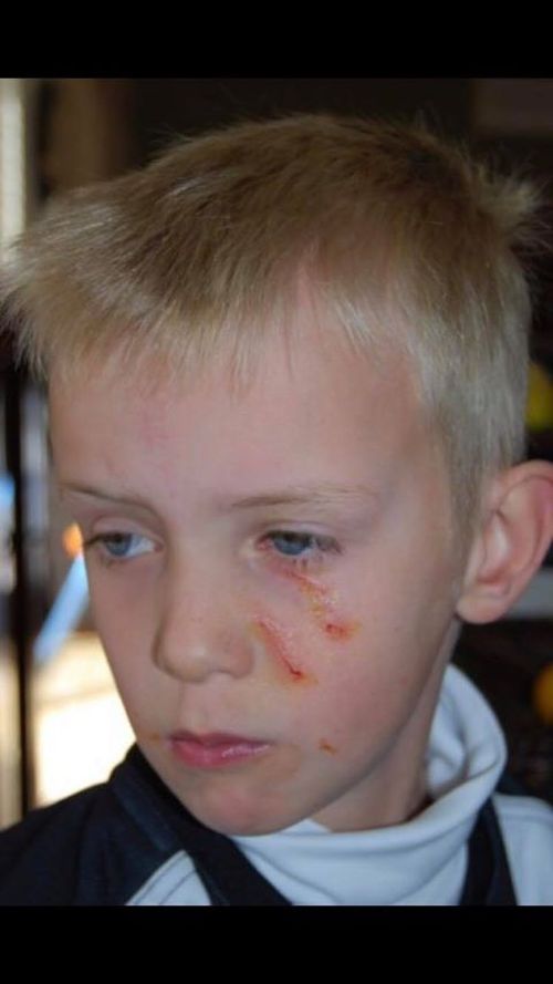 Ben Hynes was left with several scratches to his face after a magpie went against normal swooping behavior and targeted his face.  