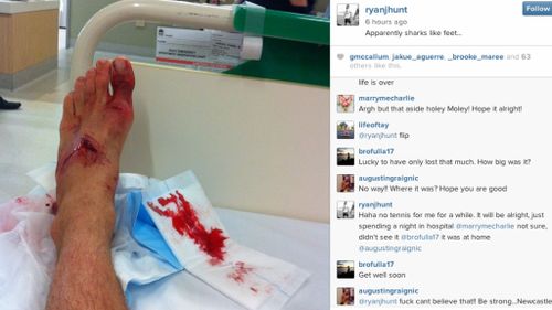 A photo of the wound Mr Hunt posted to his Instagram account. (Instagram)
