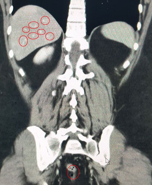 A scan showing the tumours in Ms Parkinson's liver and colon. 