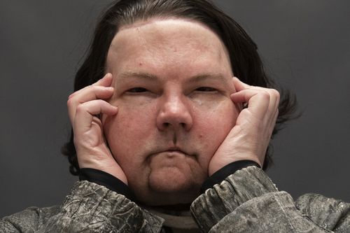 Joe DiMeo poses for a portrait, Monday, Jan. 25, 2021 at NYU Langone Health in New York, six months after an extremely rare double hand and face transplant. (AP Photo/Mark Lennihan)