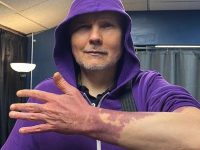 Smashing Pumpkins frontman Billy Corgan posing with his port wine birthmark.