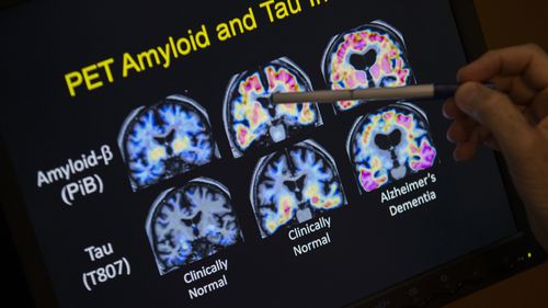 Alzheimer's disease brain scan.