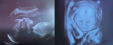 Ultrasounds photos from couple who were victim to an adoption scam. 