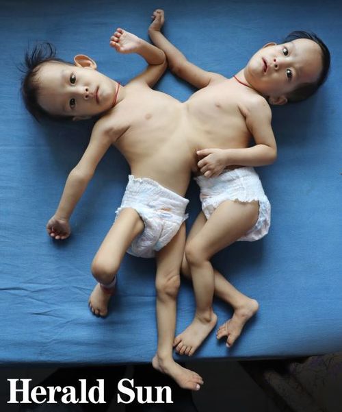 Nima and Dawa Pelden are believed to be Bhutan's first recorded conjoined twins. 