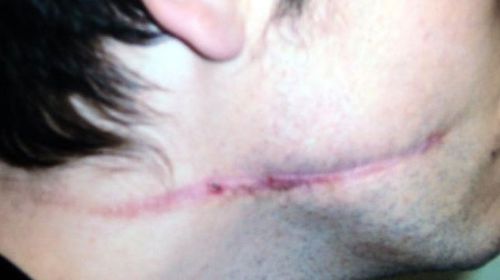 Partridge was slashed across the face in prison.