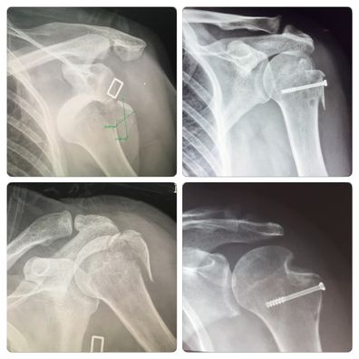 Ellen broke her shoulder in seven places after falling from a ladder.