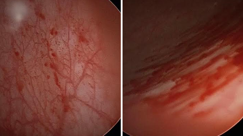 Photos taken from inside Samantha Bailey's bladder show inflammation and bleeding.