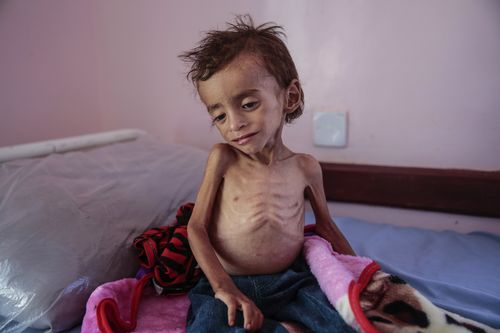 A malnourished boy sits alone at Yemen’s Aslam Health Centre in Hajjah in August.