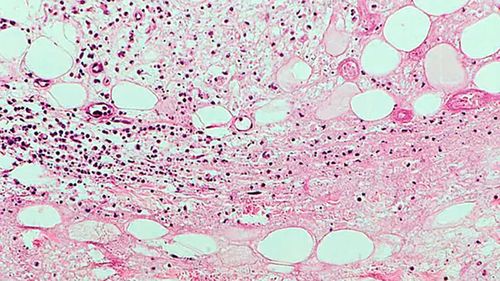 The Buruli ulcer is caused by the Mycobacterium ulcerans.