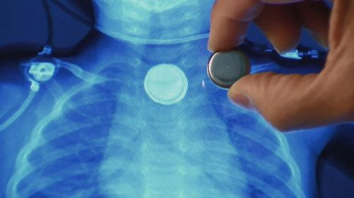 Two weeks after her first admission an X-Ray revealed a round object - a button battery - inside the child’s body. 