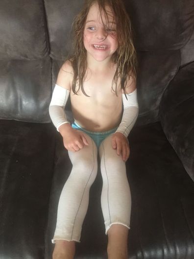 Sophie Gray wearing arm and leg wraps to manage her stranger rashes.