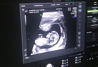 Susane and Daniel IVF ultrasound photo