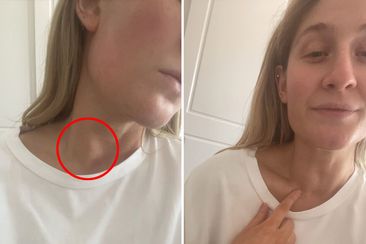 Mikaela Gangi never noticed the lump on her neck until a specialist spotted it at an IBS checkup.
