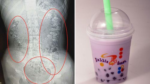 More than 100 undigested bubble tea balls found in girl's stomach