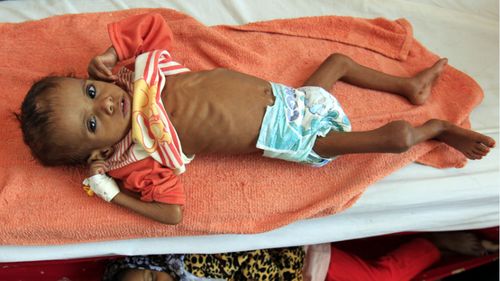 'Civilians in Yemen are not starving, they are being starved.'