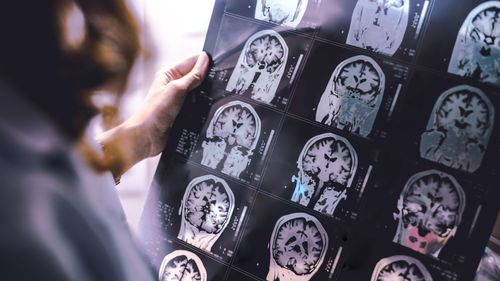 Dementia is one of the leading causes of death in Australia but a new finding could revolutionise detection and treatment. 