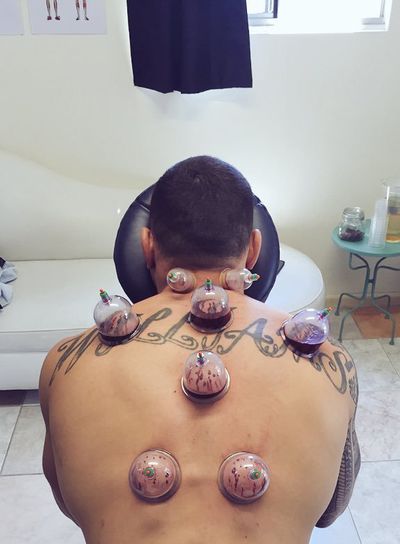 <strong>Fire cupping massage</strong>
