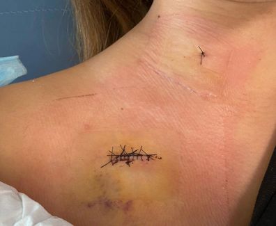 The lumps were cut out of Maddie King's neck three months after she found them.