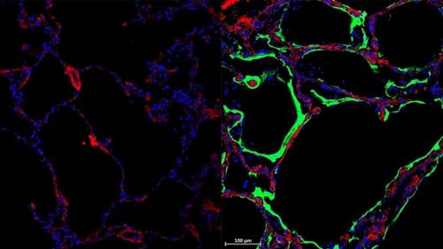 Left: Control Lung. Right: Immunofluorescent staining shows expression of new SARS-CoV-2 spike-receptor LRRC15 (green) in post-mortem lung tissue section from individual with COVID-19