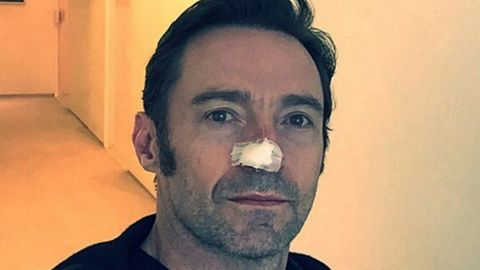 Hugh Jackman's recent treatment was the fifth to remove skin cancer cells from his nose.