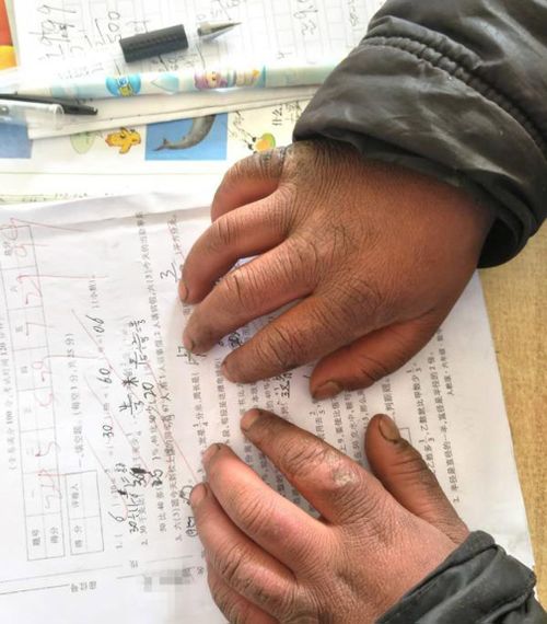 Wang was forced to complete his end-of-term exam with hands left swollen from the cold. (China News Service)