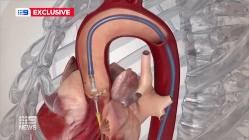 The surgery involved threading prosthetic valves through the blood vessels up to the heart.