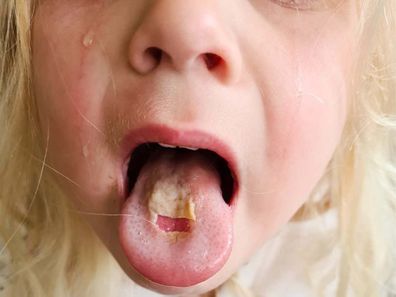 Little girl showing her burnt tongue