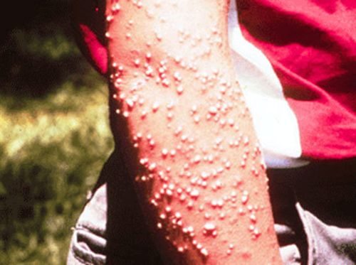 Pustules resulting from fire ant stings.
