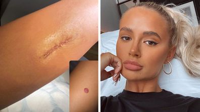 Molly-Mae Hague had a mole removed after fearing it could be cancerous.