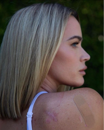 Teddi Mellencamp: close up of woman looking over her shoulder that has a bandaid and scars on it.