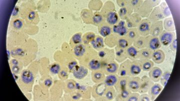 Plasmodium falciparum, one of the five parasites that causes malaria, shown growing in human red blood cells. 