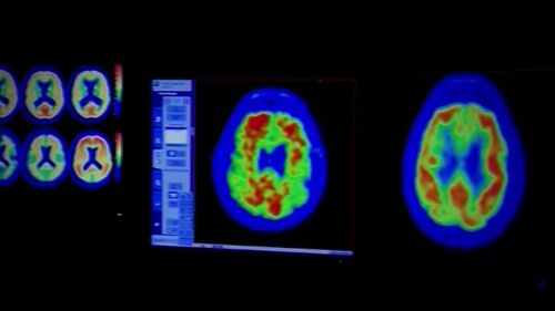 The link between an irregular heartbeat and dementia is strong according to a new report published in the American Heart Association's main journal Circulation.
