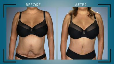 Maritza sought help from the Botched doctors for her complicated tummy tuck.