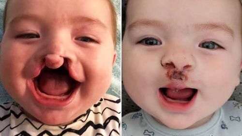 Josh, pictured before and after his first surgery. 