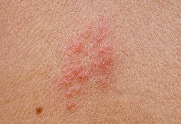 What is the common name for the herpes zoster viral disease?