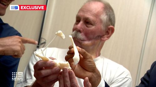 L'homme de 58 ans avait à l'origine reconstruit la mâchoire avec de l'os de sa jambe, mais cela s'est désintégré sous un traitement ultérieur contre le cancer.